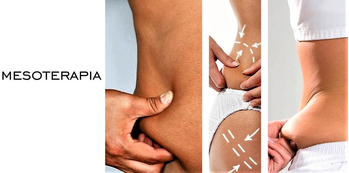 mesoterapia